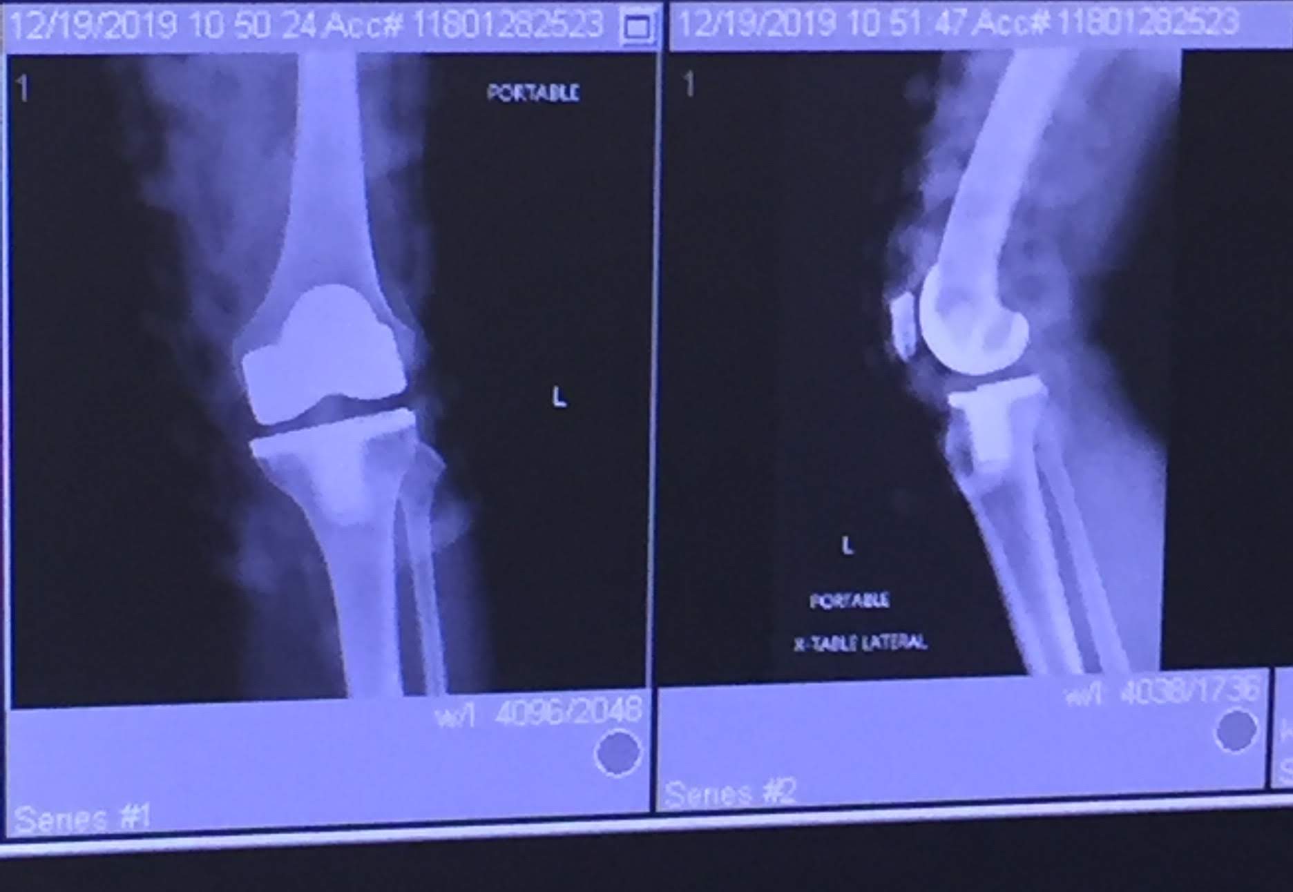 Total Knee Replacement - Day 16 photo